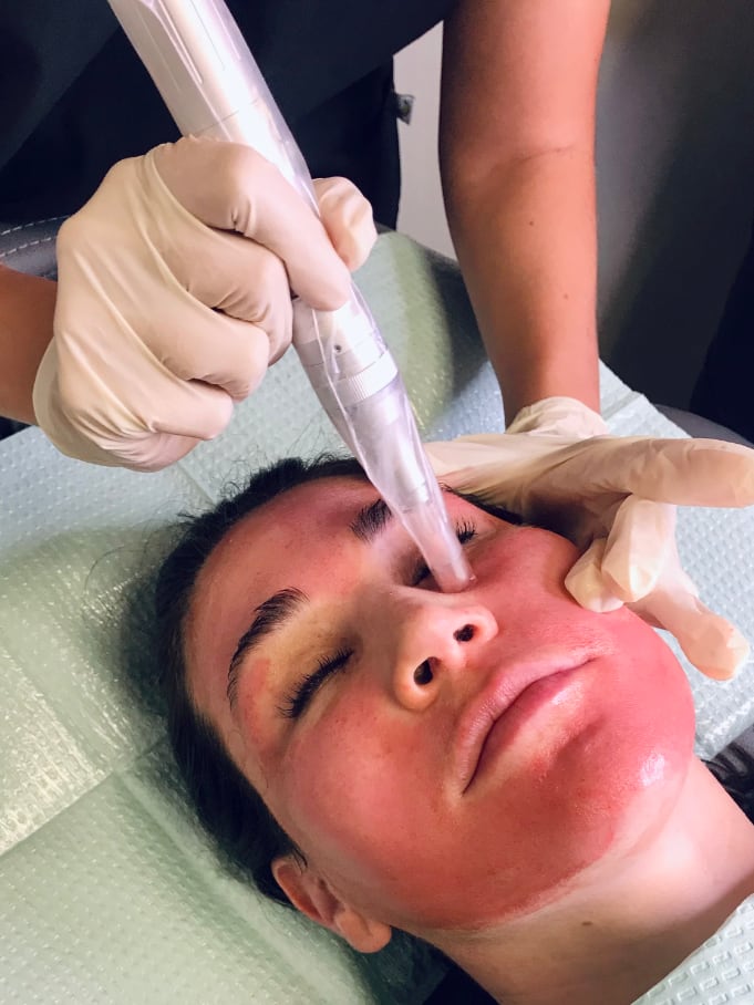 Microneedling