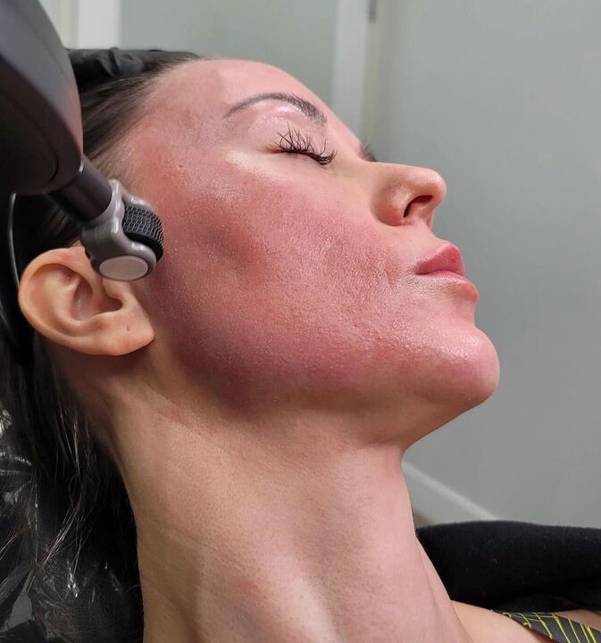 Opus Plasma Skin Tightening Consultation